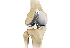 Unicompartment Knee Replacement