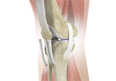 ACL Reconstruction