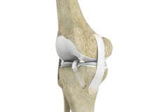 ACL Reconstruction