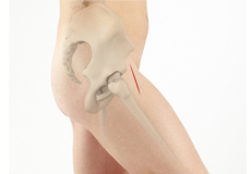 Anterior Hip Replacement