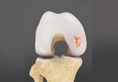 Articular Cartilage Defects