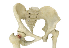 Hip Fracture Prevention