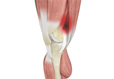 Iliotibial Band Syndrome