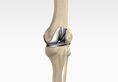 Knee Arthroplasty