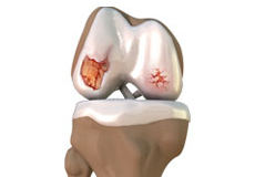 Knee Osteoarthritis