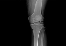 Knee Osteonecrosis