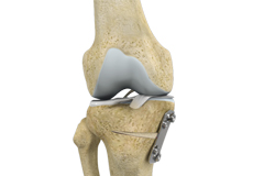 Knee Osteotomy