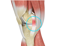 MCL Sprain