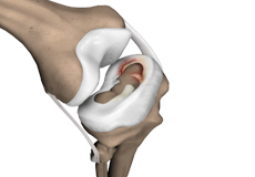 Meniscal Repair Surgery