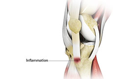 Osgood Schlatter Disease