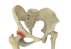 Osteoarthritis of the Hip