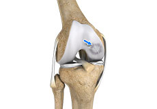 Osteochondritis Dissecans