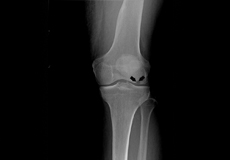 Osteonecrosis of the Knee