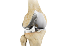 Partial Knee Replacement