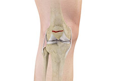 Patellar Fracture