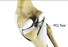 PCL Injuries