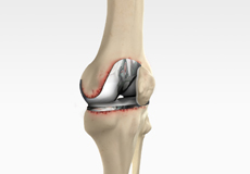 Revision Knee Replacement