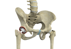 Revision Hip Replacement