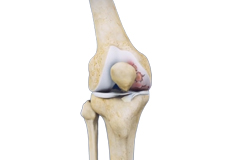 Robotic Unicondylar Knee Replacement