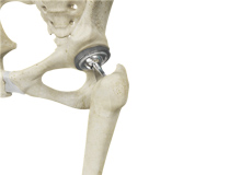 Total Hip Replacement