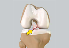 Tibial Eminence Fractures