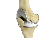 Total Knee Replacement